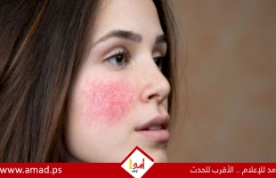 وصفات طبيعية لتهدئة احمرار البشرة بعد التعرض للشمس